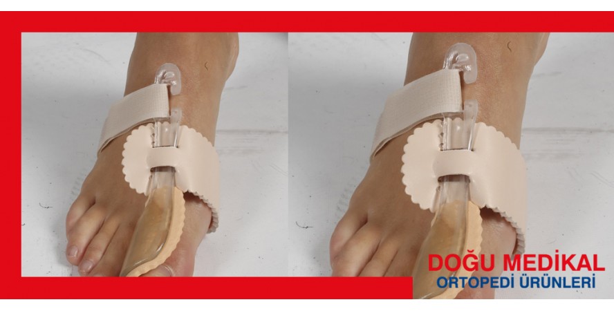 Hallux Valgus Gece Ateli Plastik